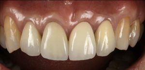 薄く折れやすい状態の前歯を、予知性の高いインプラントで治療した症例【前歯部審美症例11】